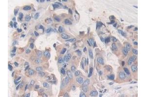 Detection of CD15 in Human Breast cancer Tissue using Polyclonal Antibody to Cluster Of Differentiation 15 (CD15)