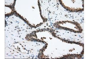 Immunohistochemical staining of paraffin-embedded Human prostate tissue using anti-ACAT2 mouse monoclonal antibody. (ACAT2 anticorps)
