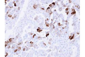 IHC-P Image Immunohistochemical analysis of paraffin-embedded OVCAR3 xenograft , using Carbonic anhydrase 2, antibody at 1:100 dilution. (CA2 anticorps)
