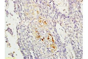 Formalin-fixed and paraffin embedded human esophageal carcinoma labeled with Anti-RAB8 Polyclonal Antibody, Unconjugated  at 1:200, followed by conjugation to the secondary antibody and DAB staining (RAB8A anticorps  (AA 101-207))