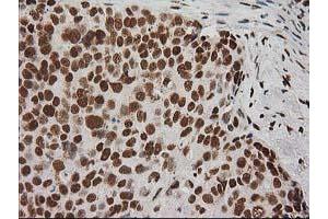 Immunohistochemical staining of paraffin-embedded Adenocarcinoma of Human breast tissue using anti-LOX mouse monoclonal antibody. (LOX anticorps  (AA 22-168))