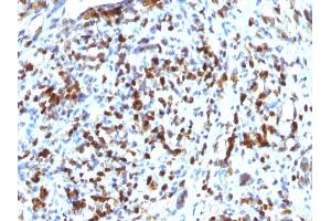 Formalin-fixed, paraffin-embedded human Rhabdomyosarcoma stained with MyoD1 Mouse Monoclonal Antibody (MYOD1/2075R).