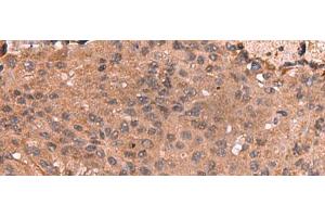 Immunohistochemistry of paraffin-embedded Human colorectal cancer tissue using IST1 Polyclonal Antibody at dilution of 1:40(x200) (IST1 anticorps)
