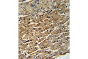 Formalin-fixed and paraffin-embedded human hepatocarcinoma with GPT Antibody (N-term ), which was peroxidase-conjugated to the secondary antibody, followed by DAB staining. (ALT anticorps  (N-Term))