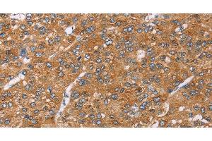 Immunohistochemistry of paraffin-embedded Human liver cancer using PAICS Polyclonal Antibody at dilution of 1:35 (PAICS anticorps)