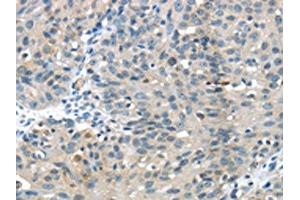 The image on the left is immunohistochemistry of paraffin-embedded Human breast cancer tissue using ABIN7129612(GLP2R Antibody) at dilution 1/30, on the right is treated with fusion protein. (GLP2R anticorps)