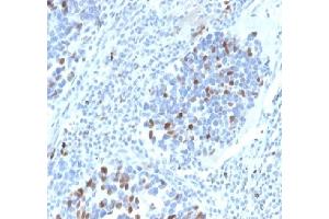 Formalin fixed paraffin embedded human lung carcinoma stained with p21 Rabbit Recombinant Monoclonal Antibody (CIP1/4377R).