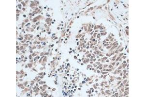 Immunohistochemistry of paraffin-embedded Human lung cancer using ZNF416 Polyclonal Antibody at dilution of 1:100 (40x lens). (ZNF416 anticorps)