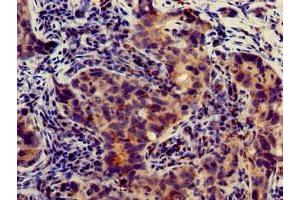 Immunohistochemistry of paraffin-embedded human pancreatic cancer using ABIN7144143 at dilution of 1:100