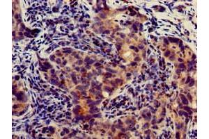 Immunohistochemistry of paraffin-embedded human pancreatic cancer using ABIN7144143 at dilution of 1:100 (SLC4A9 anticorps  (AA 114-402))