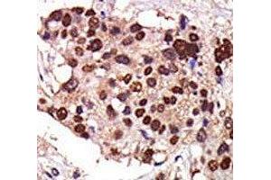 IHC analysis of FFPE human breast carcinoma tissue stained with the PKC nu antibody