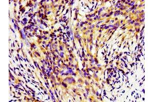 Immunohistochemistry of paraffin-embedded human pancreatic cancer using ABIN7155253 at dilution of 1:100 (HINT1 anticorps  (AA 2-126))