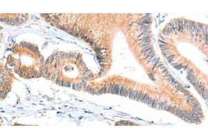 Immunohistochemistry of paraffin-embedded Human colon cancer tissue using ACSBG1 Polyclonal Antibody at dilution 1:40 (ACSBG1 anticorps)