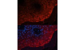 Immunofluorescence analysis of human skin cancer using S100 Polyclonal Antibody (ABIN3022395, ABIN3022396, ABIN3022397 and ABIN6218783) at dilution of 1:100 (40x lens). (S100A8 anticorps  (AA 1-93))