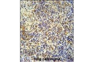 KRI1 antibody (N-term) (ABIN654199 and ABIN2844048) immunohistochemistry analysis in formalin fixed and paraffin embedded human lung carcinoma followed by peroxidase conjugation of the secondary antibody and DAB staining. (KRI1 anticorps  (N-Term))