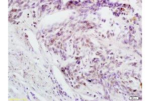Formalin-fixed and paraffin embedded human rectal carcinoma labeled with Anti-Phospho-cdc25C (Thr48) Polyclonal Antibody, Unconjugated  at 1:200 followed by conjugation to the secondary antibody and DAB