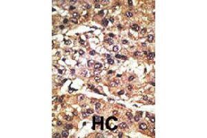 Formalin-fixed and paraffin-embedded human hepatocellular carcinoma tissue reacted with GPR37 polyclonal antibody  , which was peroxidase-conjugated to the secondary antibody, followed by DAB staining . (GPR37 anticorps  (N-Term))