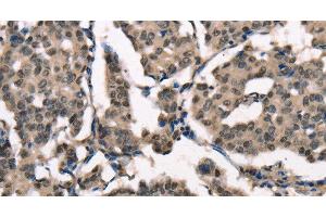 Immunohistochemistry of paraffin-embedded Human breast cancer using NSMCE3 Polyclonal Antibody at dilution of 1:40 (Necdin-Like 2 anticorps)