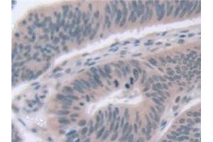 Detection of EXOSC2 in Human Colorectal cancer Tissue using Polyclonal Antibody to Exosome Component 2 (EXOSC2)