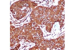 Immunohistochemical analysis of paraffin-embedded Breast cancer using PK beta 1 mouse mAb (1/200 dilution).