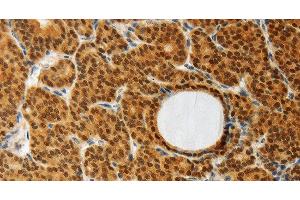 Immunohistochemistry of paraffin-embedded Human thyroid cancer using AKR1A1 Polyclonal Antibody at dilution of 1:30 (AKR1A1 anticorps)