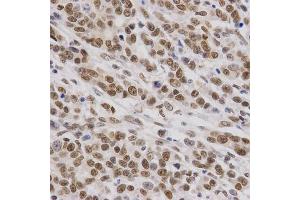Immunohistochemistry of paraffin-embedded human gastric cancer using SMARCE1 Antibody. (SMARCE1 anticorps)
