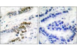 Immunohistochemistry analysis of paraffin-embedded human lung carcinoma tissue, using ERCC1 Antibody.