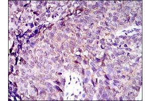 Immunohistochemical analysis of paraffin-embedded bladder cancer tissues using ABCC4 mouse mAb with DAB staining.