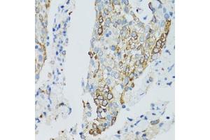 Immunohistochemistry of paraffin-embedded human lung cancer using SIRT2 antibody (ABIN3020851, ABIN3020852, ABIN3020853 and ABIN6213756) at dilution of 1:100 (40x lens).