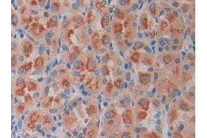 Detection of ODC in Human Stomach cancer Tissue using Polyclonal Antibody to Ornithine Decarboxylase (ODC)