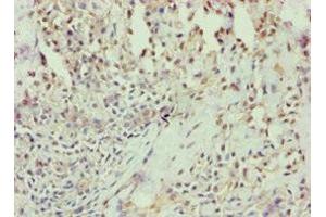 Immunohistochemistry of paraffin-embedded human breast cancer using ABIN7144294 at dilution of 1:100