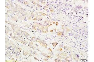 Formalin-fixed and paraffin embedded human gastric carcinoma labeled with Anti-MEK1/2(MAPKK1) Polyclonal Antibody, Unconjugated  at 1:200 followed by conjugation to the secondary antibody and DAB staining. (MEK1/2 anticorps  (AA 301-393))