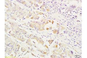 Formalin-fixed and paraffin embedded human gastric carcinoma labeled with Anti-MEK1/2(MAPKK1) Polyclonal Antibody, Unconjugated  at 1:200 followed by conjugation to the secondary antibody and DAB staining.