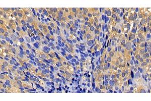 Detection of CASP1 in Human Breast cancer Tissue using Polyclonal Antibody to Caspase 1 (CASP1)