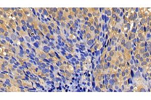Detection of CASP1 in Human Breast cancer Tissue using Polyclonal Antibody to Caspase 1 (CASP1) (Caspase 1 anticorps  (AA 317-404))