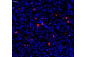 Immunofluorescence of paraffin embedded human subcutaneous transplant tumor(Raji) using c-caspase3 (ABIN7073336) at dilution of 1:1200 (400x lens)