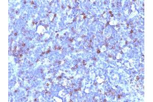 Formalin-fixed, paraffin-embedded human Lymphoma stained with CD43 Mouse Monoclonal Antibody (SPN/1094). (CD43 anticorps)