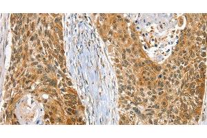 Immunohistochemistry of paraffin-embedded Human esophagus cancer using RAB27A Polyclonal Antibody at dilution of 1:30