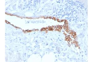 Formalin-fixed, paraffin-embedded human Lung Mesothelioma stained with Mesothelin Mouse Monoclonal Antibody (MSLN/3384).