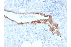 Formalin-fixed, paraffin-embedded human Lung Mesothelioma stained with Mesothelin Mouse Monoclonal Antibody (MSLN/3384). (Mesothelin anticorps  (AA 273-407))