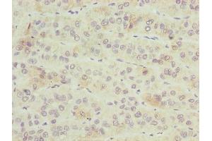 Immunohistochemistry of paraffin-embedded human liver cancer using ABIN7176441 at dilution of 1:100