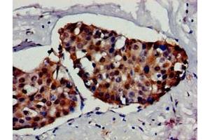 Immunohistochemistry of paraffin-embedded human breast cancer using ABIN7154889 at dilution of 1:100