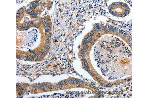 Immunohistochemistry of Human esophagus cancer using EFNB2 Polyclonal Antibody at dilution of 1:80