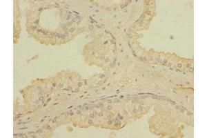 Immunohistochemistry of paraffin-embedded human prostata cancer using ABIN7171721 at dilution of 1:100 (CCDC79 anticorps  (AA 301-550))
