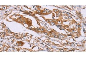 Immunohistochemistry of paraffin-embedded Human colon cancer using OS9 Polyclonal Antibody at dilution of 1:30 (OS9 anticorps)