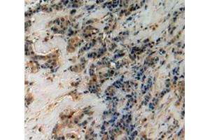 IHC-P analysis of Human Breast Cancer Tissue, with DAB staining. (CHI3L1 anticorps  (AA 112-377))