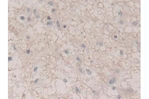 Detection of UCRP in Human Glioma Tissue using Polyclonal Antibody to Ubiquitin Cross Reactive Protein (UCRP) (CLRN1 Antisense RNA 1 (CLRN1-AS1) (AA 2-157) anticorps)