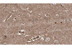 ABIN6279389 at 1/100 staining Human brain cancer tissue by IHC-P. (HACE1 anticorps  (C-Term))
