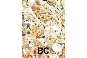 Formalin-fixed and paraffin-embedded human cancer tissue reacted with PRKCA polyclonal antibody  , which was peroxidase-conjugated to the secondary antibody, followed by DAB staining . (PKC alpha anticorps  (C-Term))