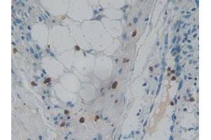 Detection of RNASE3 in Human Skin cancer Tissue using Polyclonal Antibody to Ribonuclease A3 (RNASE3)